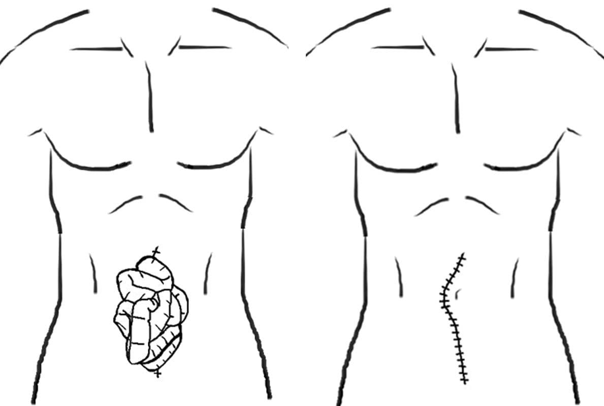 Il enlève les points d'une intervention, mais un violent éternuement lui fait sortir les intestins de l'abdomen 3 Illustrazione dell'esame addominale iniziale (a sinistra) e dopo l'operazione di riduzione dell'intestino tenue fuoriuscito (a destra). Credit: Jones J. et al. American Journal of Medical Case Reports 2024.