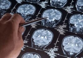 Certaines personnes sont curieusement résistantes à la maladie d'Alzheimer. Pourquoi 48 Alzheimer