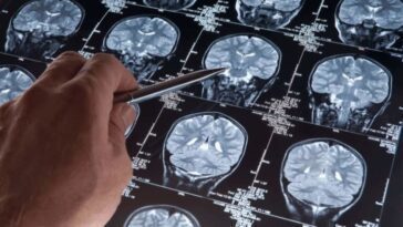 Certaines personnes sont curieusement résistantes à la maladie d'Alzheimer. Pourquoi 24 Alzheimer