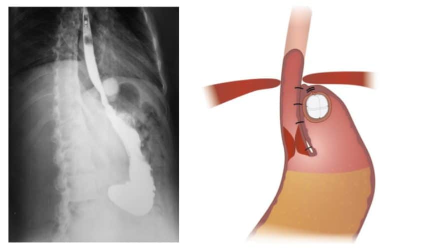 Le reflux peut être traité avec un nouveau dispositif: il empêche la remontée des acides de l'estomac 3 Il dispositivo RefluxStop viene inserito in una piccola aderenza che viene costruita nella parte superiore dello stomaco / Credit: Implantica