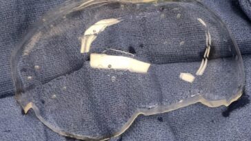 Implantation du premier crâne en plastique transparent au monde: à quoi sert-il de voir le cerveau 1 Crédit : Todd Patterson / Université de Californie du Sud