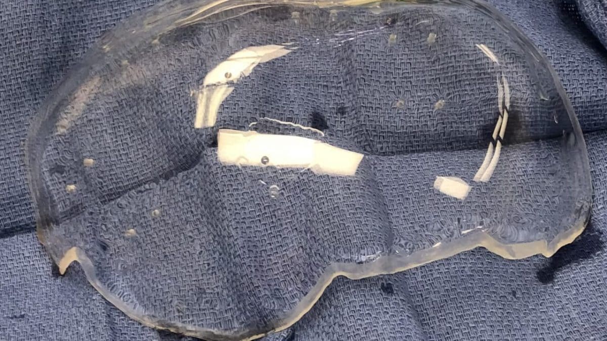 Implantation du premier crâne en plastique transparent au monde: à quoi sert-il de voir le cerveau 2 Crédit : Todd Patterson / Université de Californie du Sud