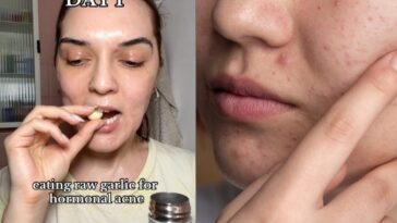 L'ail cru est-il vraiment bon pour la peau acnéique? Les réponses du dermatologue 26 TIKTOK | Capture d'écran d'un post de @cystur