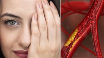 Les signes du cholestérol élevé se voient aussi sur le visage, les mains et les jambes : Comment les reconnaître 25 Immagine