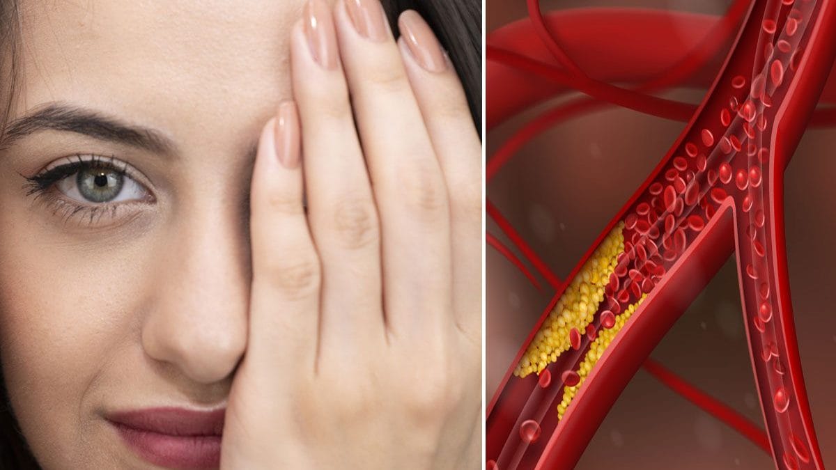 Les signes du cholestérol élevé se voient aussi sur le visage, les mains et les jambes : Comment les reconnaître 2 Immagine