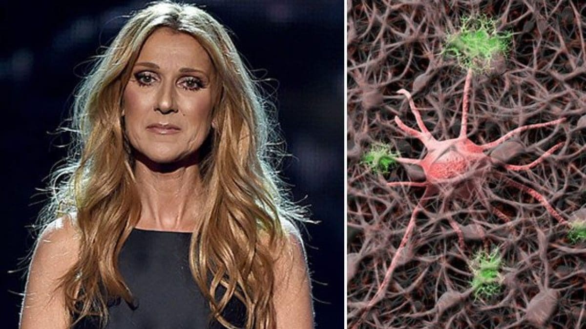 Qu'est-ce que le syndrome de la personne rigide : symptômes et traitement de la maladie de Céline Dion 2 Céline Dion, la chanteuse canadienne souffre du syndrome de la personne raide, une maladie neurologique rare et progressive d'origine auto-immune qui provoque des symptômes tels que raideur musculaire et spasmes douloureux.