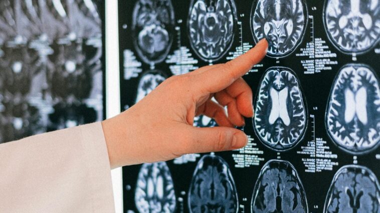 Un dispositif implanté dans le cerveau peut guérir l'épilepsie: la première intervention chez un enfant de 12 ans 1 Immagine