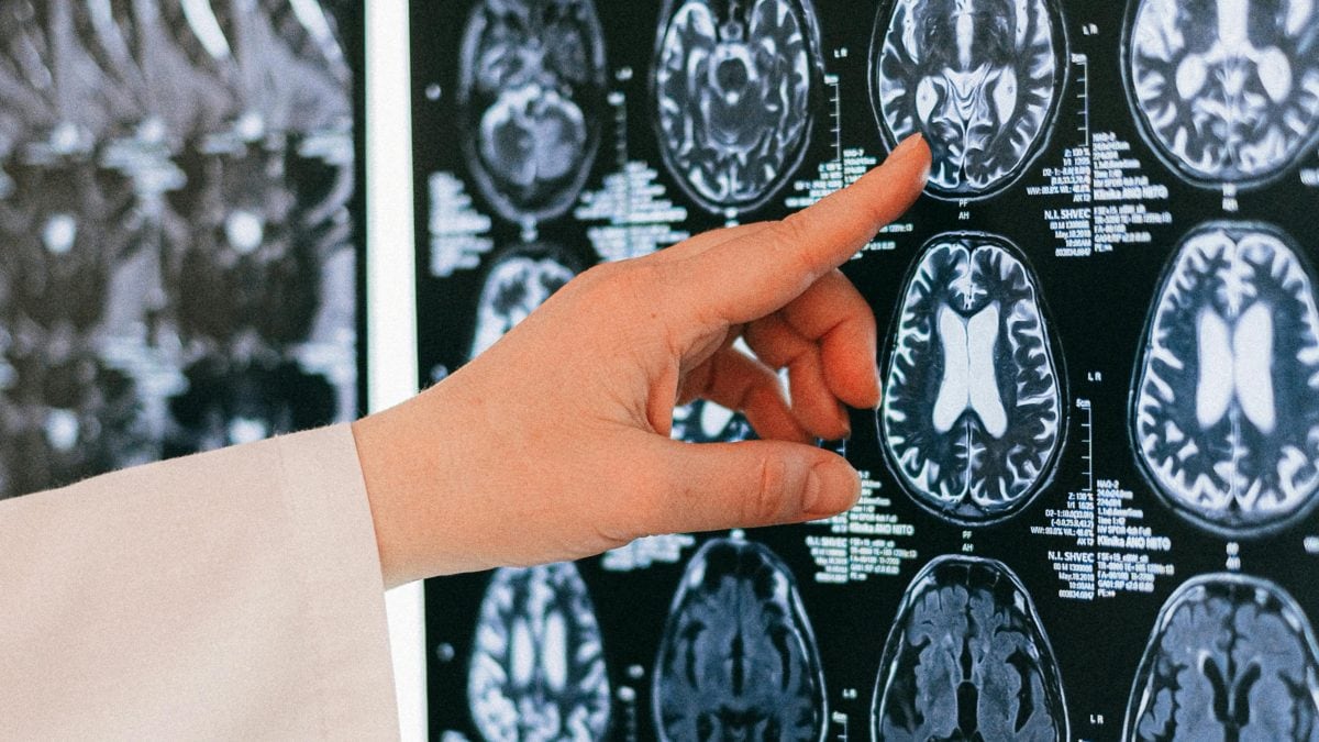 Un dispositif implanté dans le cerveau peut guérir l'épilepsie: la première intervention chez un enfant de 12 ans 2 Immagine
