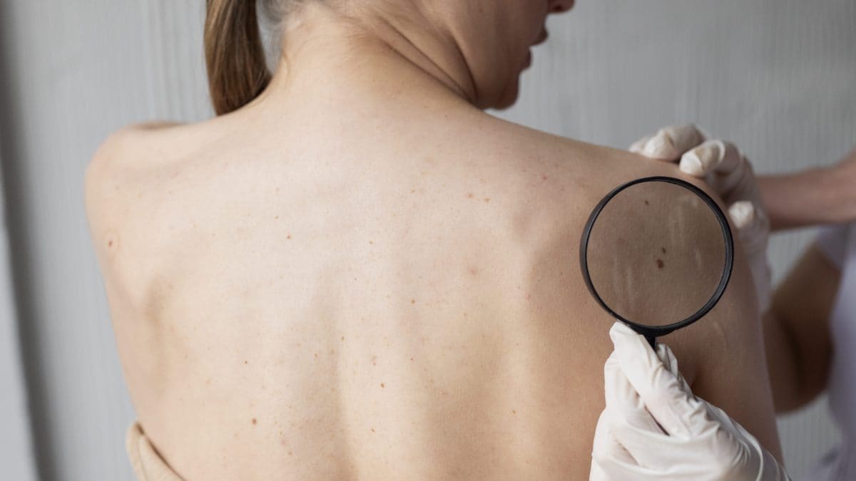 Le mélanome métastatique peut être bloqué par ces deux médicaments : les résultats après dix ans depuis le diagnostic 2 Image