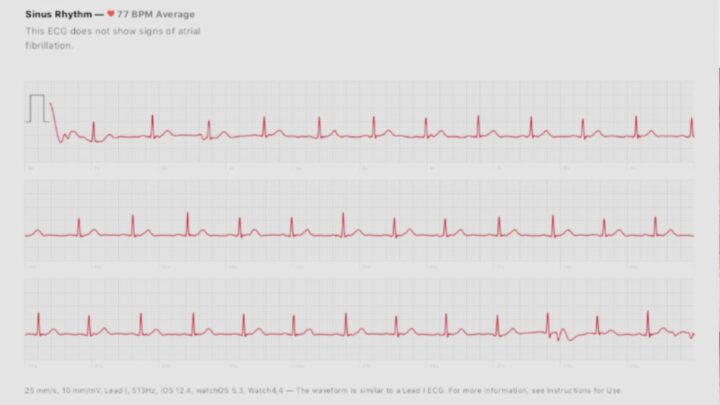 1720111457 748 Apple Watch peut detecter la principale cause des crises cardiaques