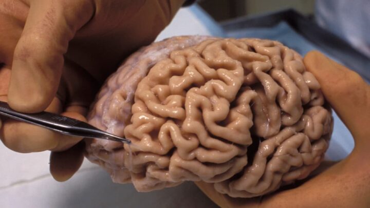 1720360694 283 Le risque de maladie dAlzheimer est fortement influence par le