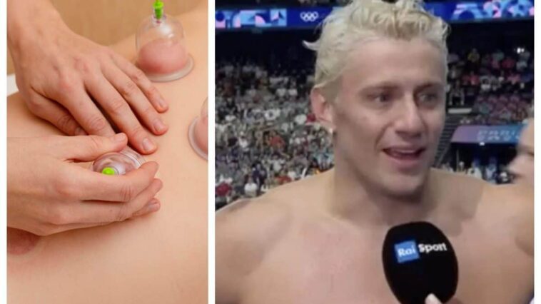 Les doutes sur la technique utilisée par les nageurs aux JO : "Nous n'avons pas de preuves sur les effets du cupping" 1 Image