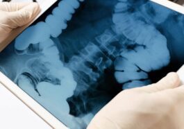 Tumeur au côlon, pour le test il suffit d'un prélèvement : la révolution dans le diagnostic vient des USA 86 Image