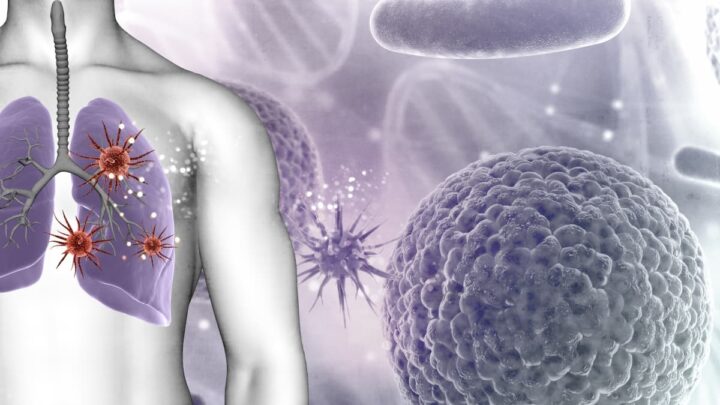 Un patient reçoit le premier vaccin au monde contre le cancer du poumon 3 Cancer du poumon