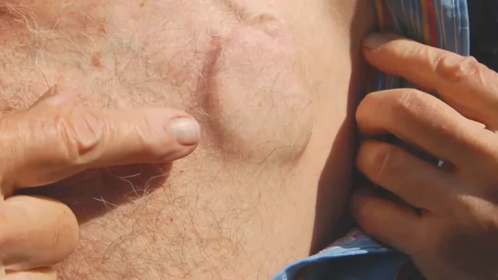 Un ancien dirigeant de Microsoft évoque que l'Apple Watch lui a sauvé la vie 5 Image d'un pacemaker implanté