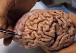 Grupo de cientistas utiliza IA em 1,6 milhões de exames cerebrais para prever a demência