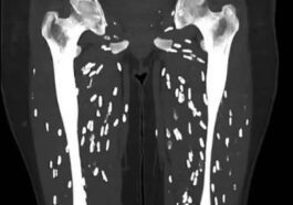 Un scanner des jambes montre les kystes causés par la cysticercose, la maladie causée par l'ingestion d'œufs de ver solitaire du porc / Crédit : https://linkinghub.elsevier.com/retrieve/pii/S000992600090494X