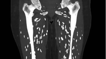 Un post sur X montre les effets dévastateurs de la cysticercose, la maladie causée par le ténia du porc 10 Un scanner des jambes montre les kystes causés par la cysticercose, la maladie causée par l'ingestion d'œufs de ver solitaire du porc / Crédit : https://linkinghub.elsevier.com/retrieve/pii/S000992600090494X
