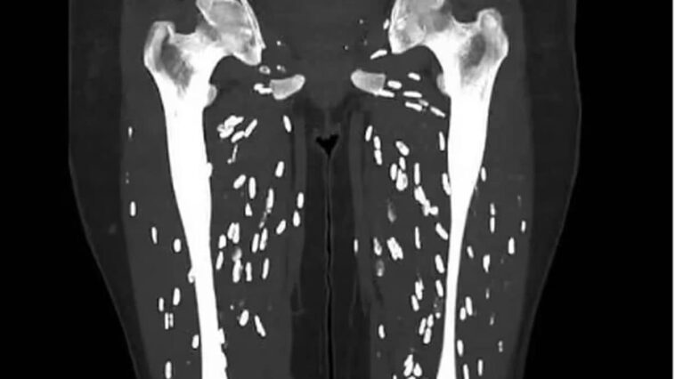 Un post sur X montre les effets dévastateurs de la cysticercose, la maladie causée par le ténia du porc 1 Un scanner des jambes montre les kystes causés par la cysticercose, la maladie causée par l'ingestion d'œufs de ver solitaire du porc / Crédit : https://linkinghub.elsevier.com/retrieve/pii/S000992600090494X