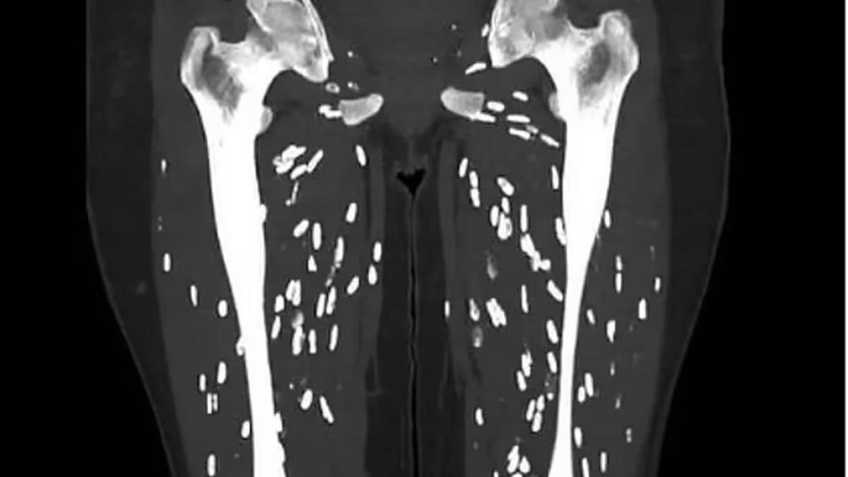 Un post sur X montre les effets dévastateurs de la cysticercose, la maladie causée par le ténia du porc 2 Un scanner des jambes montre les kystes causés par la cysticercose, la maladie causée par l'ingestion d'œufs de ver solitaire du porc / Crédit : https://linkinghub.elsevier.com/retrieve/pii/S000992600090494X