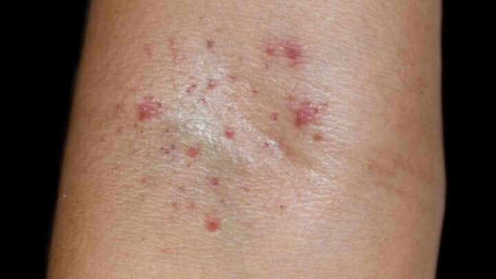 Des scientifiques alertent sur le risque de la Dengue, affecte les destinations de vacances en Europe 3 Réaction de la peau à la dengue