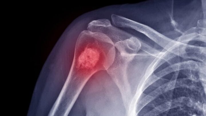 Verre toxique : des scientifiques ont découvert un traitement potentiel pour le cancer des os 3 Ossos