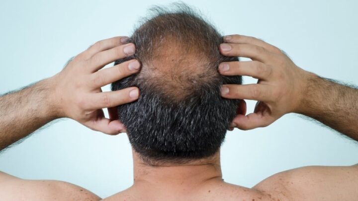Des scientifiques ont découvert un sucre qui pourrait résoudre la calvitie masculine 3 Calvitie