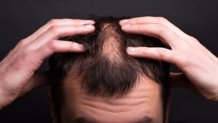 Des scientifiques ont découvert un sucre qui pourrait résoudre la calvitie masculine 6 Calvitie