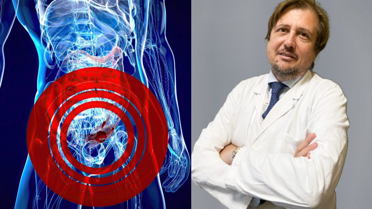 Cancer du côlon-rectum, quels sont les tests pour le découvrir : "Le risque peut être réduit par l'alimentation" 2 Image