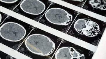 De la structure du cerveau, on peut prédire si une personne souffrira de dépression : l'hypothèse d'une étude 8 Image