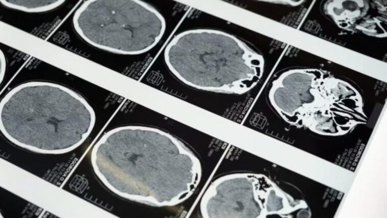 De la structure du cerveau, on peut prédire si une personne souffrira de dépression : l'hypothèse d'une étude 1 Image