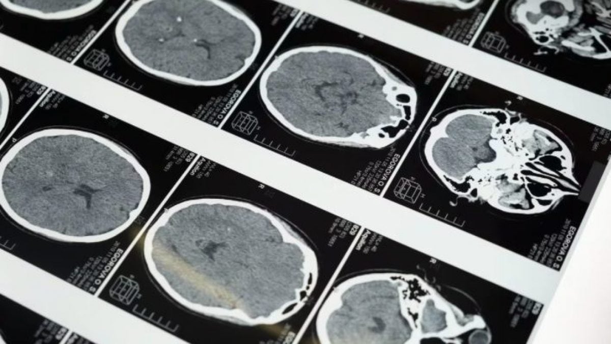 De la structure du cerveau, on peut prédire si une personne souffrira de dépression : l'hypothèse d'une étude 2 Image