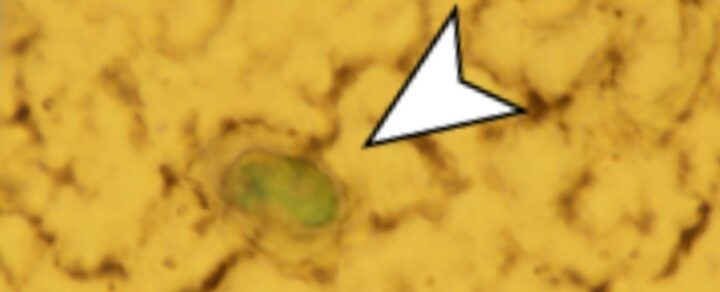 Nouveau study détecte des microplastiques dans le tissu cérébral humain 3 Nouveau study detecte des microplastiques dans le tissu cerebral humain