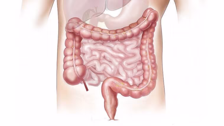 Qu'est-ce que le cancer du côlon, la maladie qui a touché Totò Schillaci : symptômes, causes et traitements 1 Image