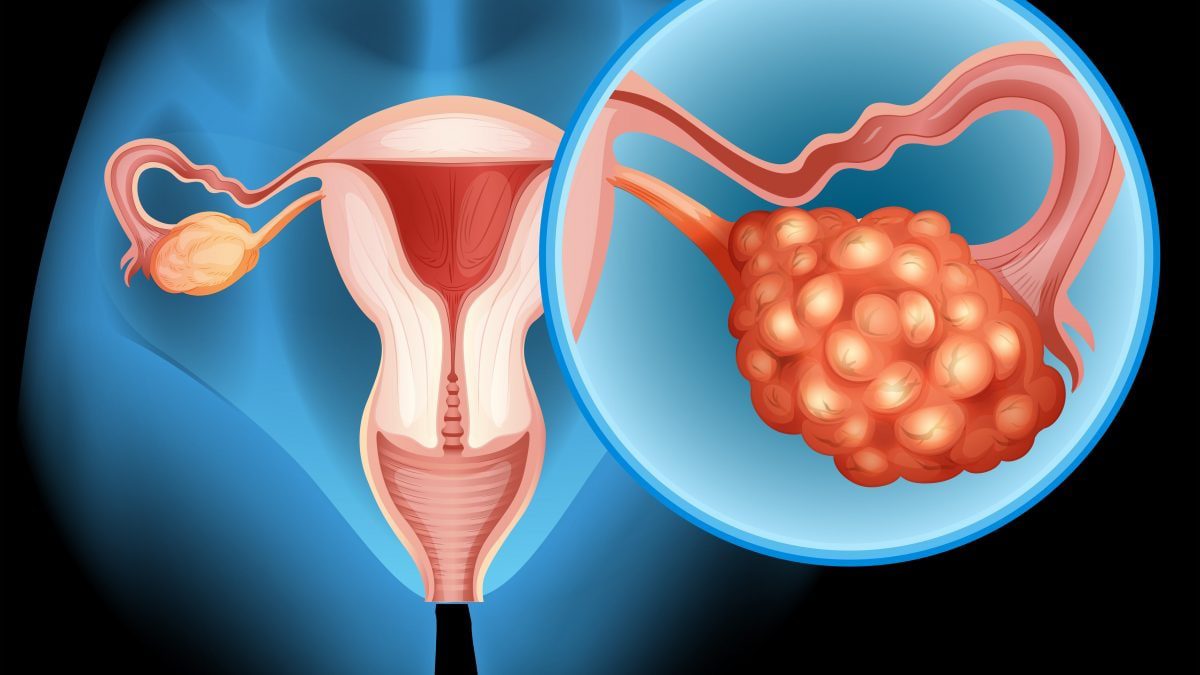 Début de l'étude pour développer le premier vaccin contre le cancer de l'ovaire : comment ça fonctionne 2 Image