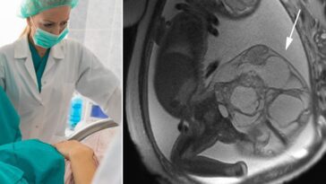 Fait une échographie pendant la grossesse mais découvre que sa fille a une tumeur au coccyx 24 L'échographie morphologique (à droite) montre le teratome sacro-coccigien, un type de tumeur qui se développe chez le fœtus pendant la grossesse / Crédit : Texas Children's Pavilion for Women
