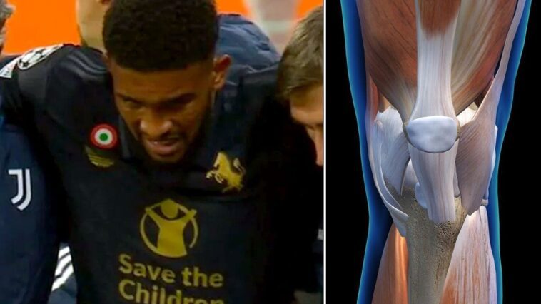 Qu'est-ce que la rupture du ligament croisé antérieur et combien de temps faudra-t-il à Bremer pour se remettre de sa blessure 1 a sinistra, Gleison Bremer mentre lascia il campo in seguito all'infortunio al ginocchio sinistro durante la partita di Champions League a Lipsia