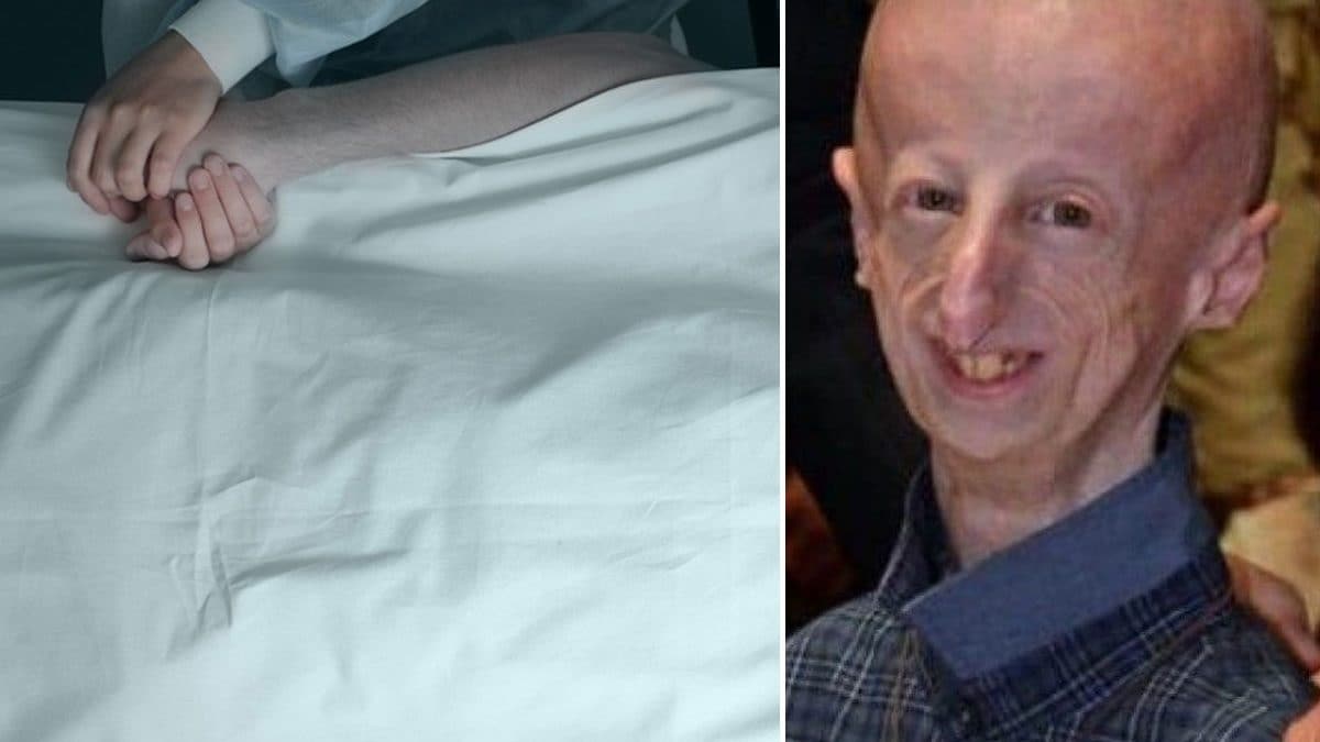 Qu'est-ce que le don de son corps à la science, le dernier cadeau de Sammy Basso à la recherche sur la Progeria 2 Sammy Basso, mort samedi dernier à 28 ans : il a donné son corps à la science pour aider la recherche à trouver un remède à la progeria de Hutchinson-Gilford