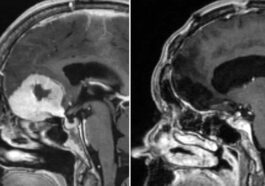 Un scan de Doreen Adams avec sa tumeur au cerveau montrée en blanc (gauche) et après qu'elle ait été retirée par le sourcil (droite) / Photo NHS Grampian