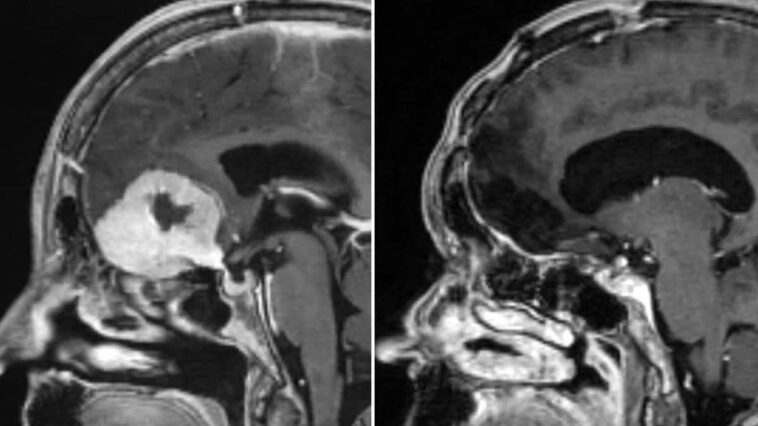 Une révolution dans la chirurgie cérébrale : découvrez la technique moins invasive qui change tout 1 Un scan de Doreen Adams avec sa tumeur au cerveau montrée en blanc (gauche) et après qu'elle ait été retirée par le sourcil (droite) / Photo NHS Grampian
