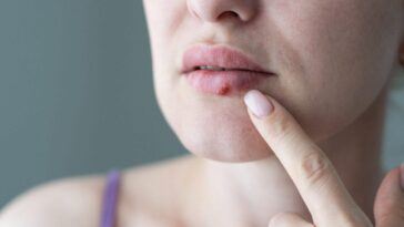 Un virus de l'herpès modifié réduit considérablement le cancer de la peau avancé : des espoirs contre le mélanome 16 Image