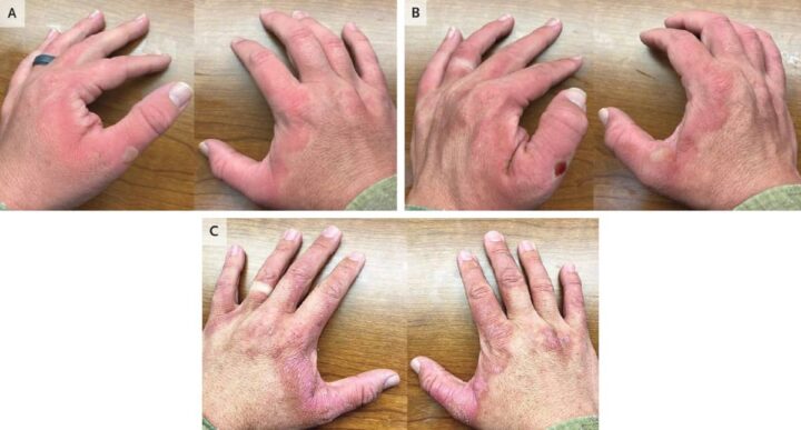 Quand le soleil rencontre le citron : une réaction brûlante qui aurait pu être évitée 3 1733153800 430 Un homme souffre pendant des mois a cause dune brulure