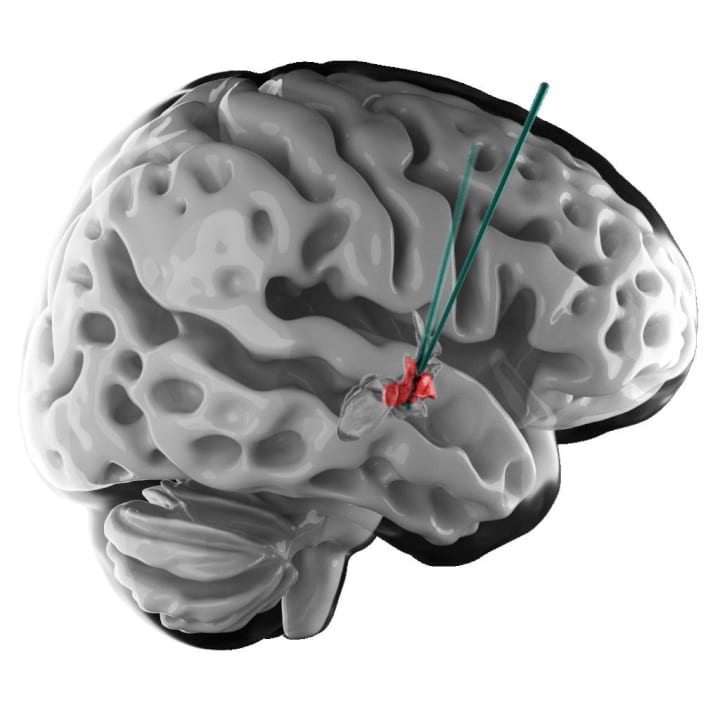Des patients paralysés retrouvent la marche grâce à des électrodes implantées dans leur cerveau 3 Électrode dans le cerveau