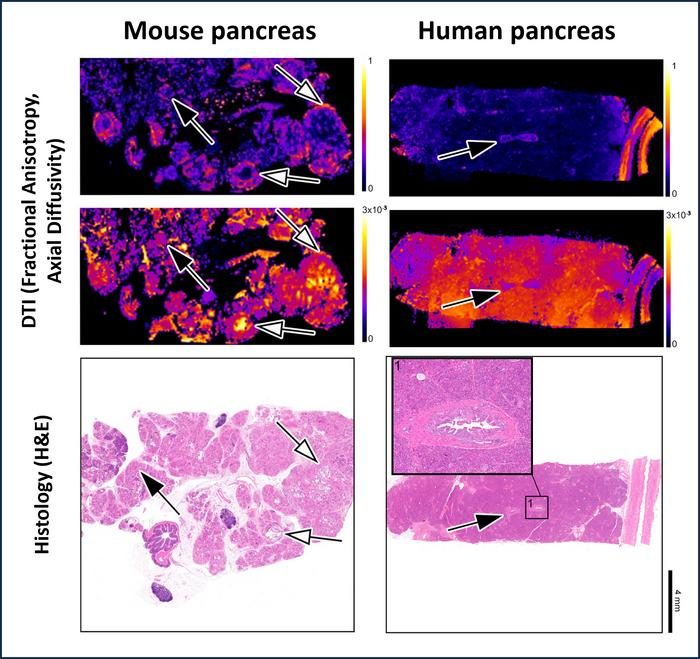 Cancer du pancréas : des lésions précancéreuses détectées pour la première fois par IRM, une lueur d'espoir pour la guérison 3 Les lésions précancéreuses observées avec la DTI et l'examen histologique. Crédit : Bilreiro C, et al. Investigative Radiology, 2024