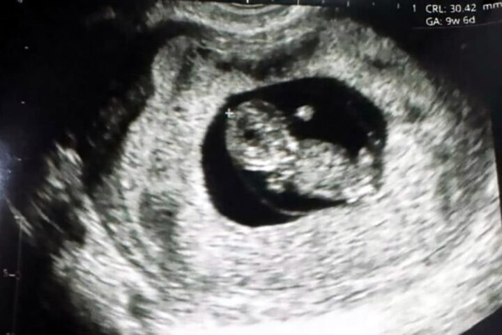 Naît le premier bébé conçu grâce à une technologie de fertilité révolutionnaire 5 Échographie des neuf semaines du "bébé Fertilo". Crédit : Gameto