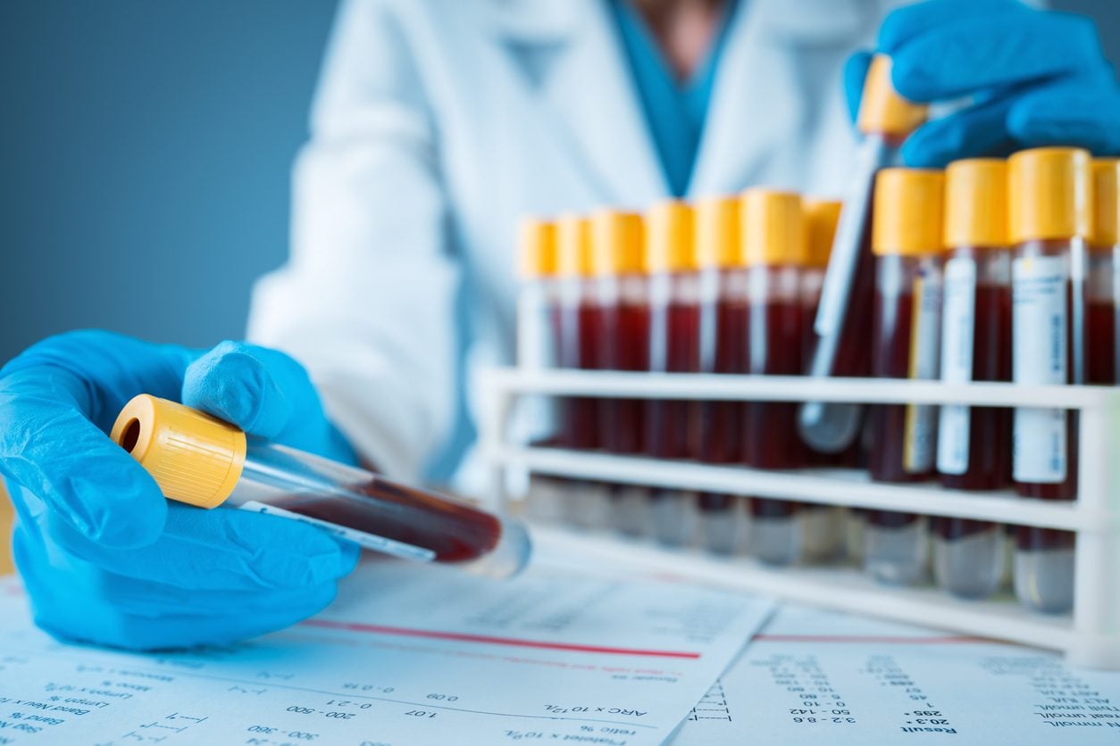 Un simple et nouveau test sanguin peut identifier Alzheimer avec une précision de 90%