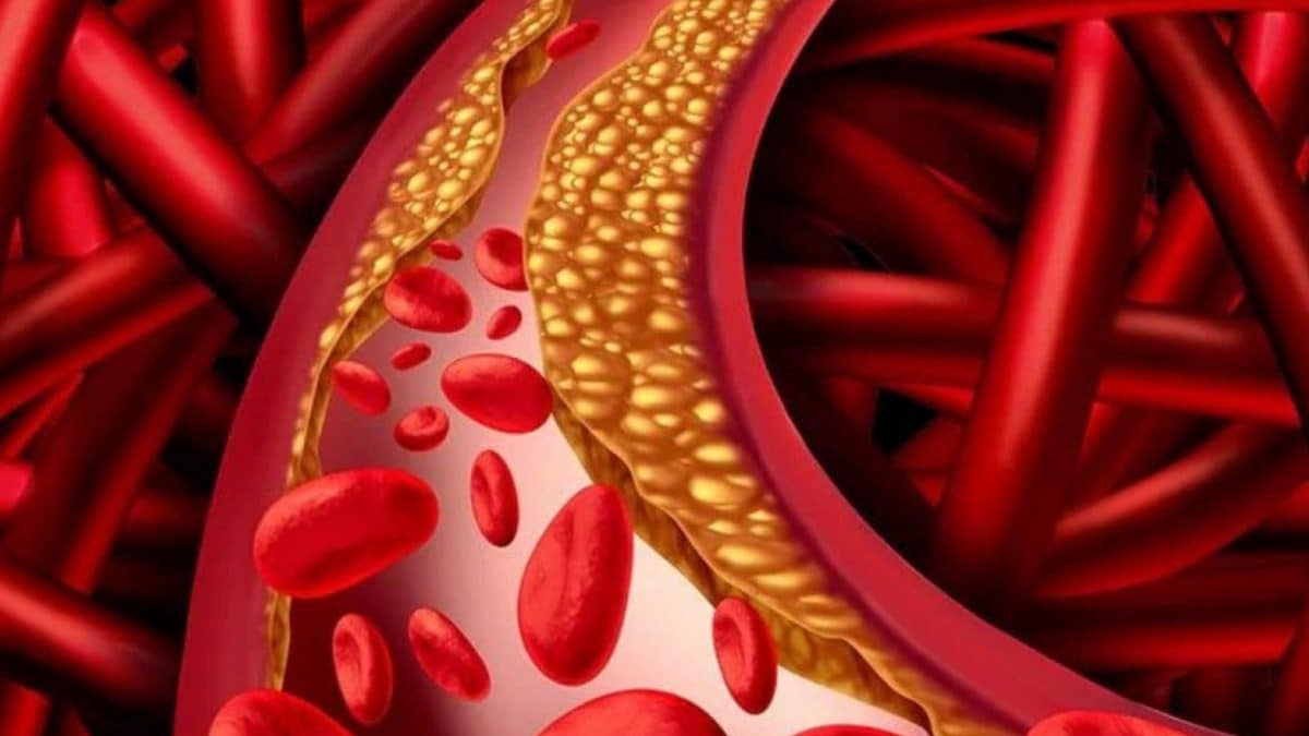 Ce qui fait grimper le cholestérol mauvais dans le sang : une étude révèle les risques d'infarctus et d' AVC 2 Image