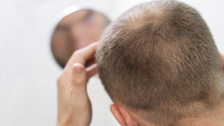La substance naturelle qui lutte contre la chute des cheveux : les résultats d'une étude sur l'alopécie 1 Immagine