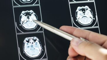 Quand arriveront les nouveaux médicaments contre l'Alzheimer ? Un expert révèle : "Le début d'une nouvelle ère" 28 Image