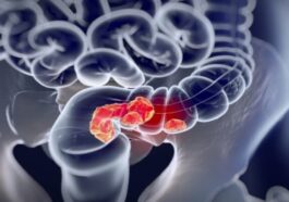 Médicament contre le cancer du rectum : une "réponse clinique sans précédent" 10 Médicament contre le cancer du rectum : une "réponse clinique sans précédent"